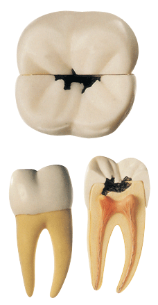 磨牙蛀牙模型