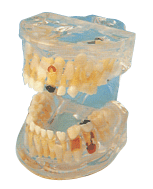 透明乳牙病理模型